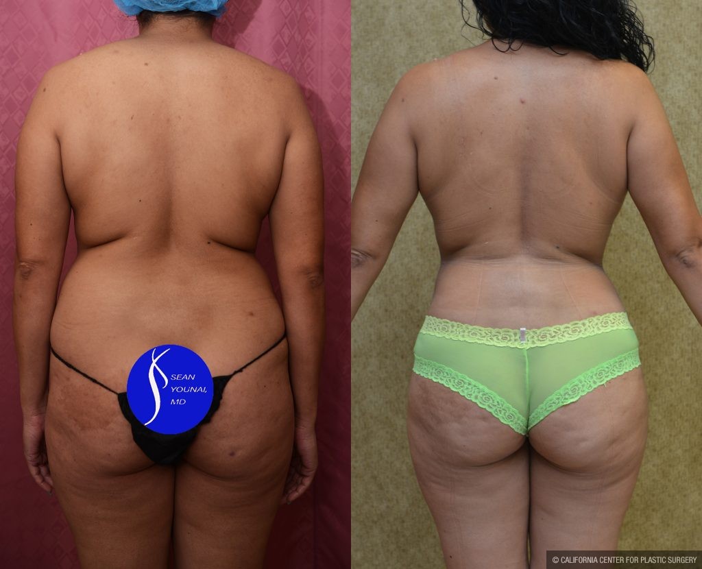 Mommy Makeover Before & After Patient #13563