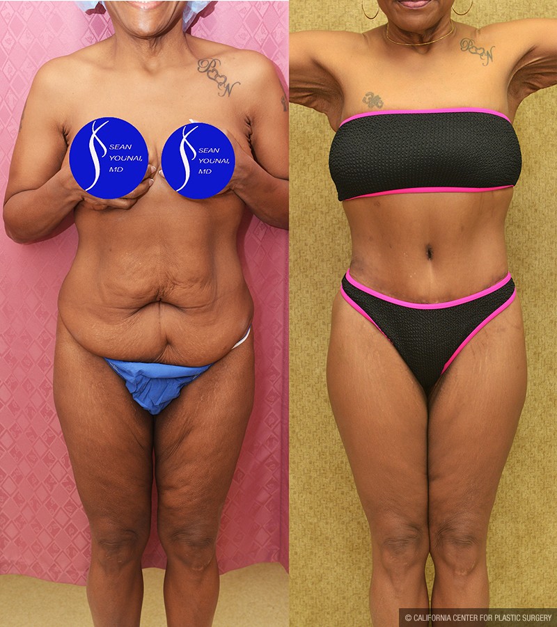 Body Lift Before & After Patient #13677