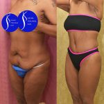 Body Lift Before & After Patient #13677