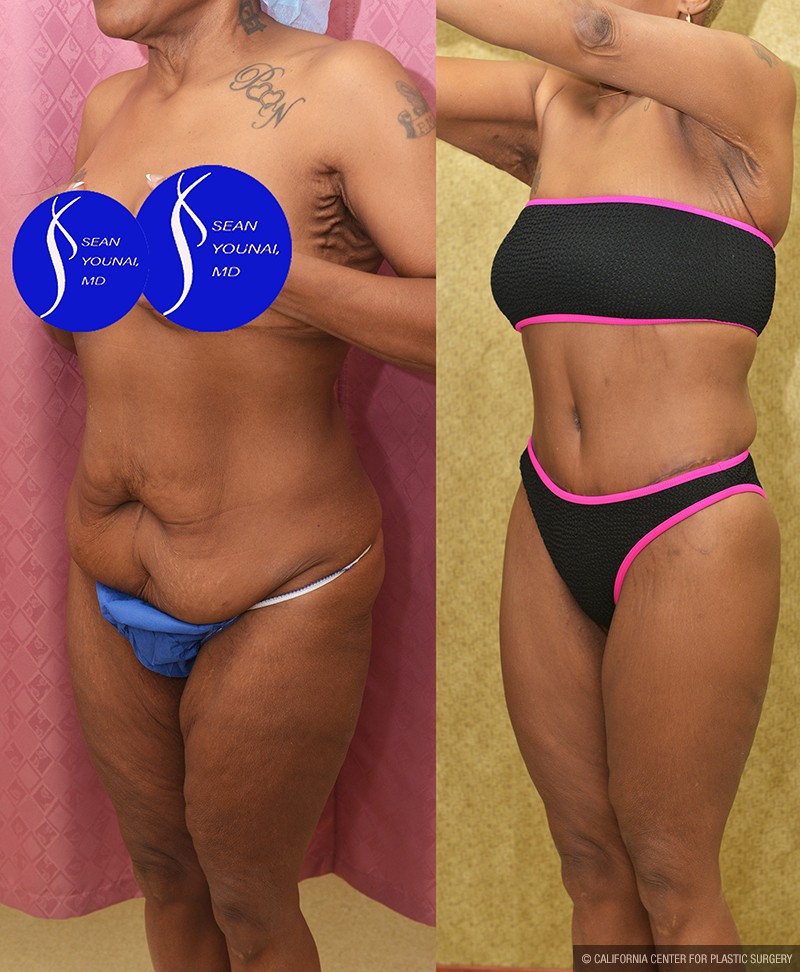 Body Lift Before & After Patient #13677