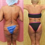 Body Lift Before & After Patient #13677