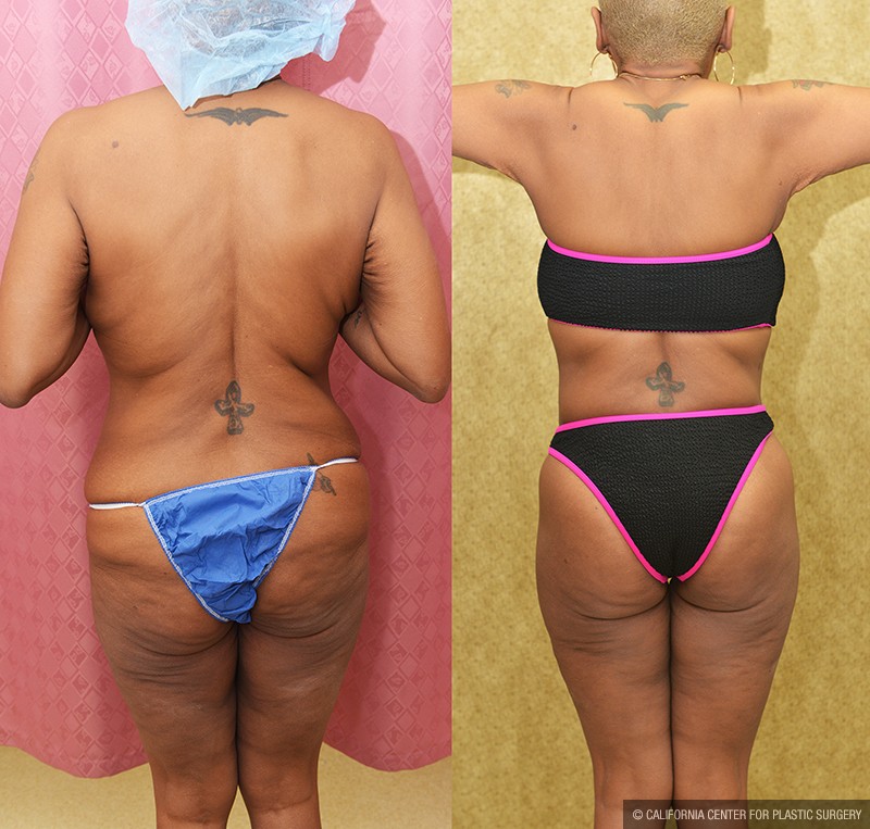 Body Lift Before & After Patient #13677