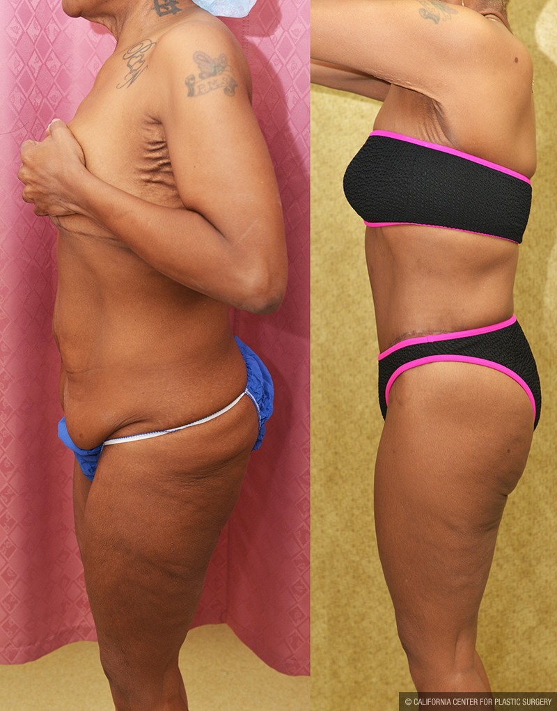 Body Lift Before & After Patient #13677