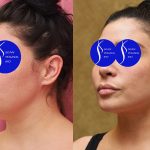 Neck & Face Liposuction Before & After Patient #13678