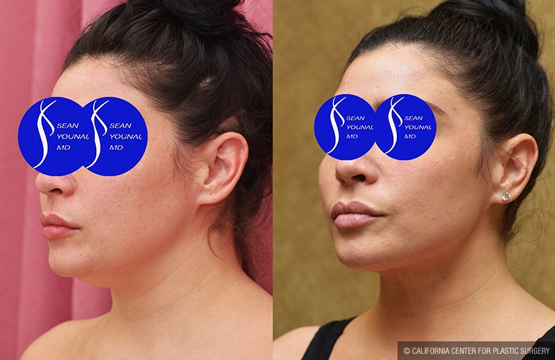 Neck & Face Liposuction Before & After Patient #13678