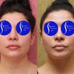 Neck & Face Liposuction Before & After Patient #13678