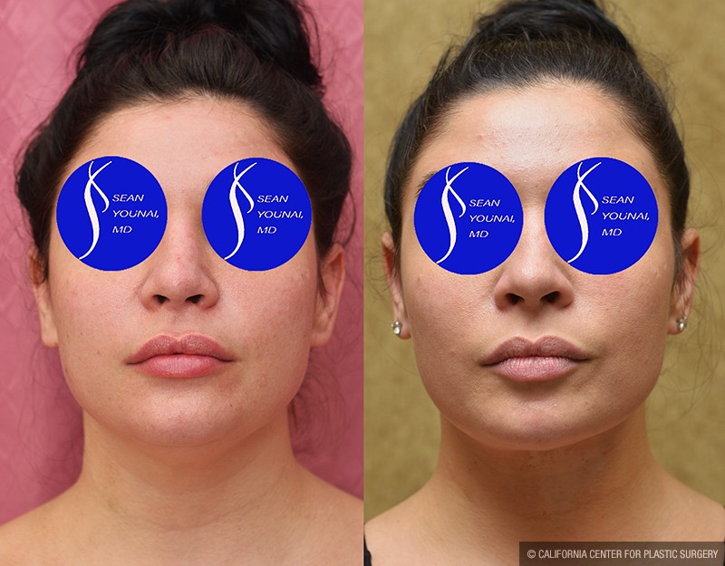 Neck & Face Liposuction Before & After Patient #13678