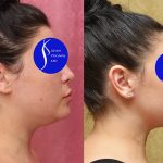 Neck & Face Liposuction Before & After Patient #13678