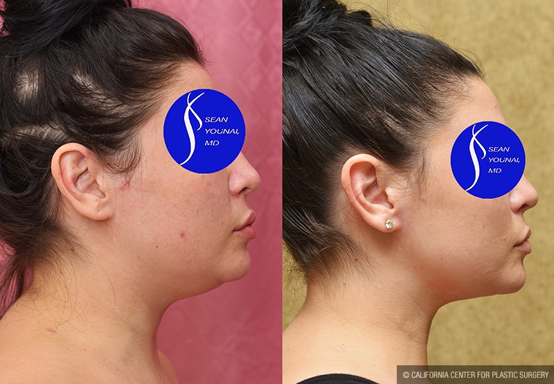 Neck & Face Liposuction Before & After Patient #13678