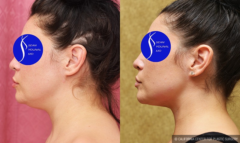Neck & Face Liposuction Before & After Patient #13678