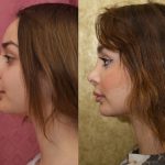 Rhinoplasty - Caucasian Before & After Patient #13682