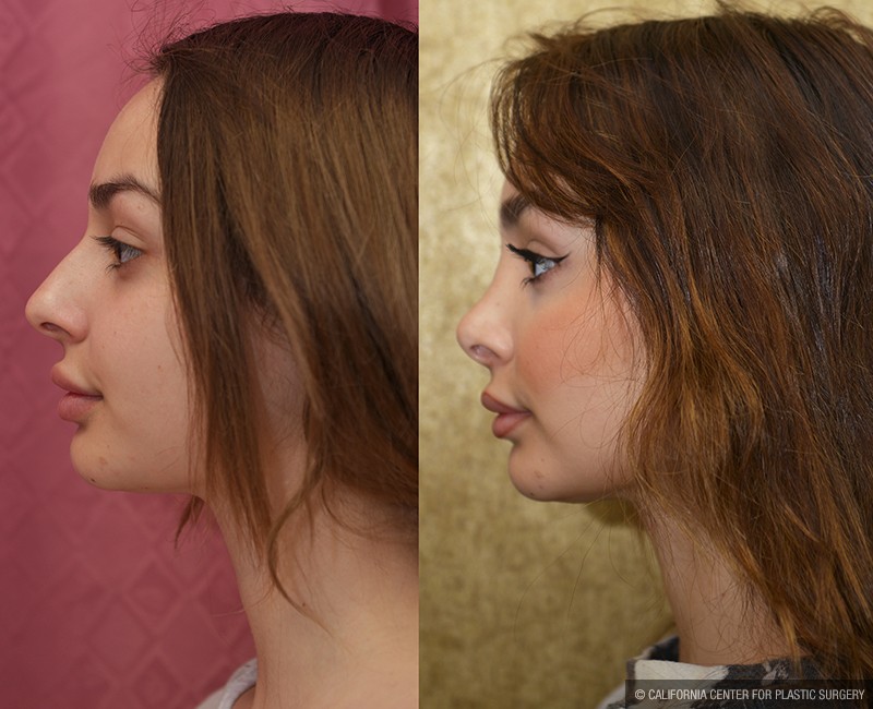 Rhinoplasty - Caucasian Before & After Patient #13682