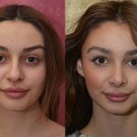 Rhinoplasty - Caucasian Before & After Patient #13682