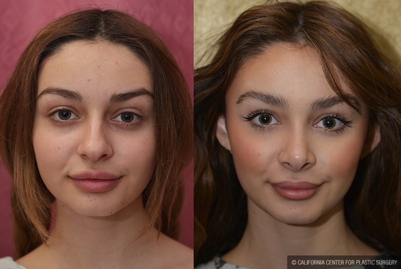 Rhinoplasty - Caucasian Before & After Patient #13682