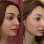 Rhinoplasty - Caucasian Before & After Patient #13682