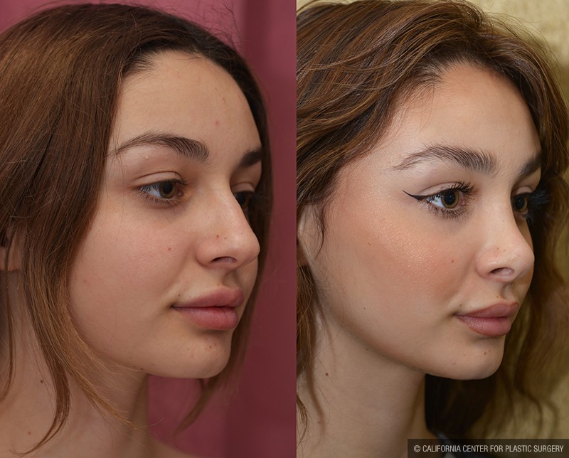 Rhinoplasty - Caucasian Before & After Patient #13682