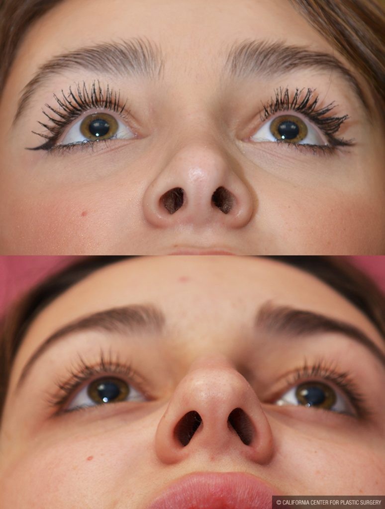 Rhinoplasty - Caucasian Before & After Patient #13682