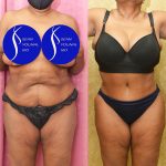 African American Tummy Tuck (Abdominoplasty) Before & After Patient #13683