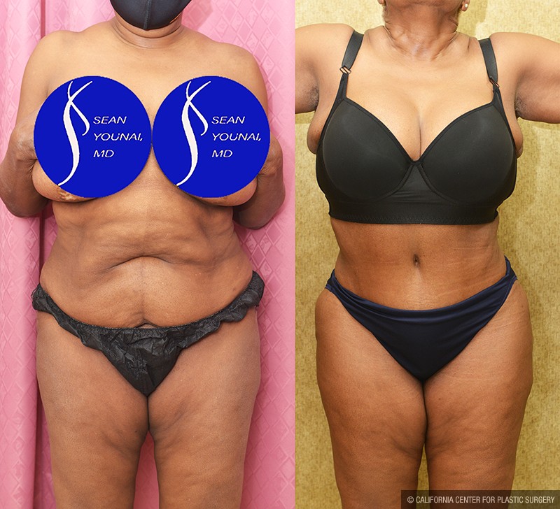 African American Tummy Tuck (Abdominoplasty) Before & After Patient #13683