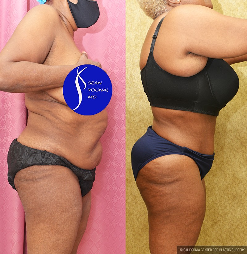 African American Tummy Tuck (Abdominoplasty) Before & After Patient #13683