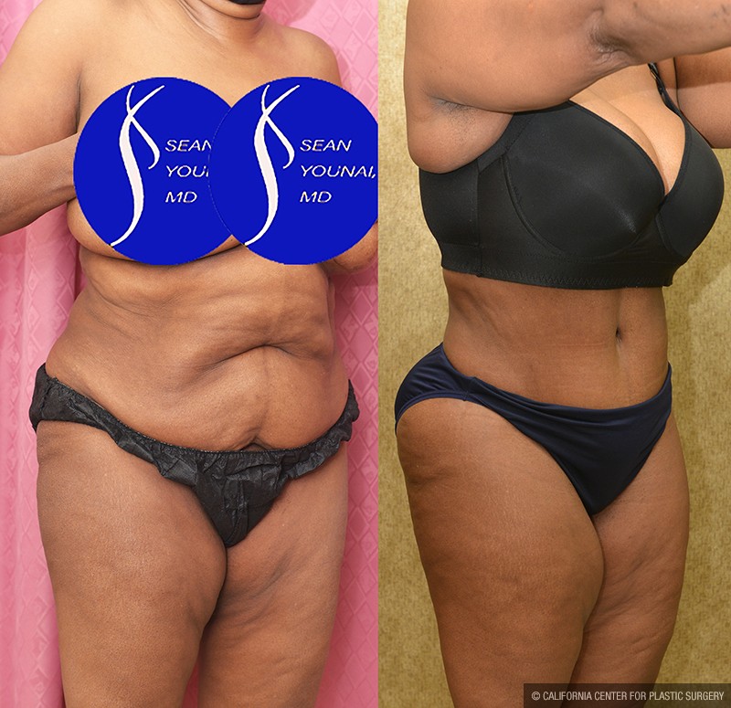 African American Tummy Tuck (Abdominoplasty) Before & After Patient #13683