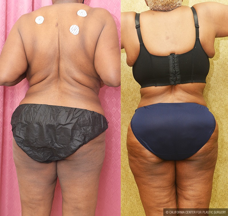 African American Tummy Tuck (Abdominoplasty) Before & After Patient #13683
