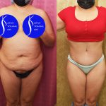 Tummy Tuck (Abdominoplasty) Medium Size Before & After Patient #13685
