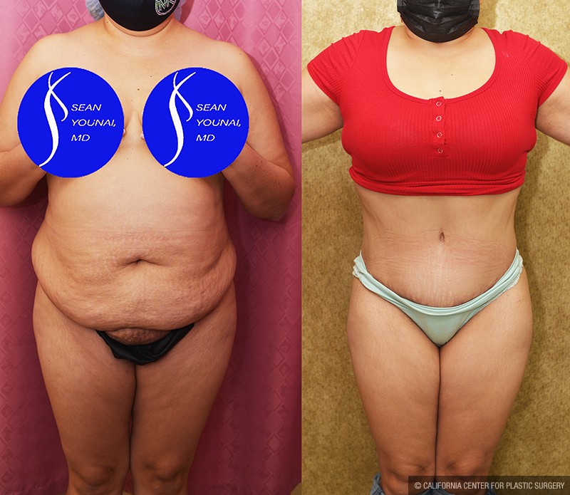 Tummy Tuck (Abdominoplasty) Medium Size Before & After Patient #13685