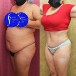 Tummy Tuck (Abdominoplasty) Medium Size Before & After Patient #13685