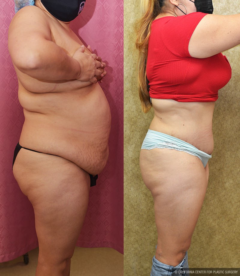 Tummy Tuck (Abdominoplasty) Medium Size Before & After Patient #13685