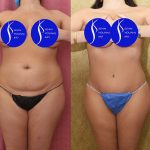 Tummy Tuck (Abdominoplasty) Medium Size Before & After Patient #13686