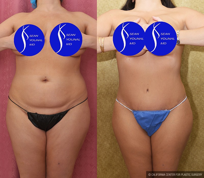 Tummy Tuck (Abdominoplasty) Medium Size Before & After Patient #13686