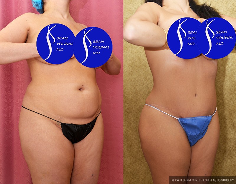 Tummy Tuck (Abdominoplasty) Medium Size Before & After Patient #13686