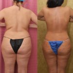 Tummy Tuck (Abdominoplasty) Medium Size Before & After Patient #13686
