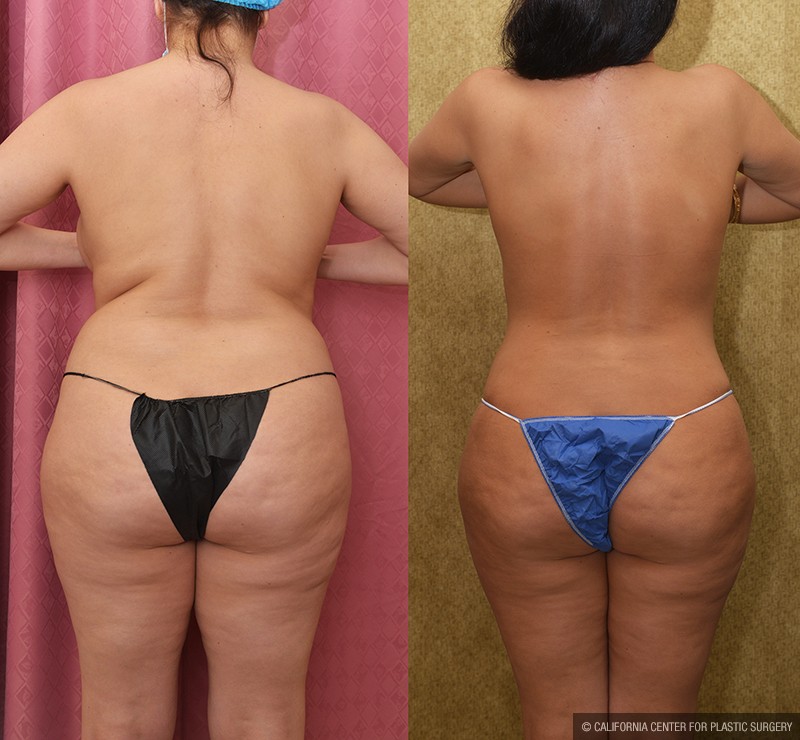 Tummy Tuck (Abdominoplasty) Medium Size Before & After Patient #13686