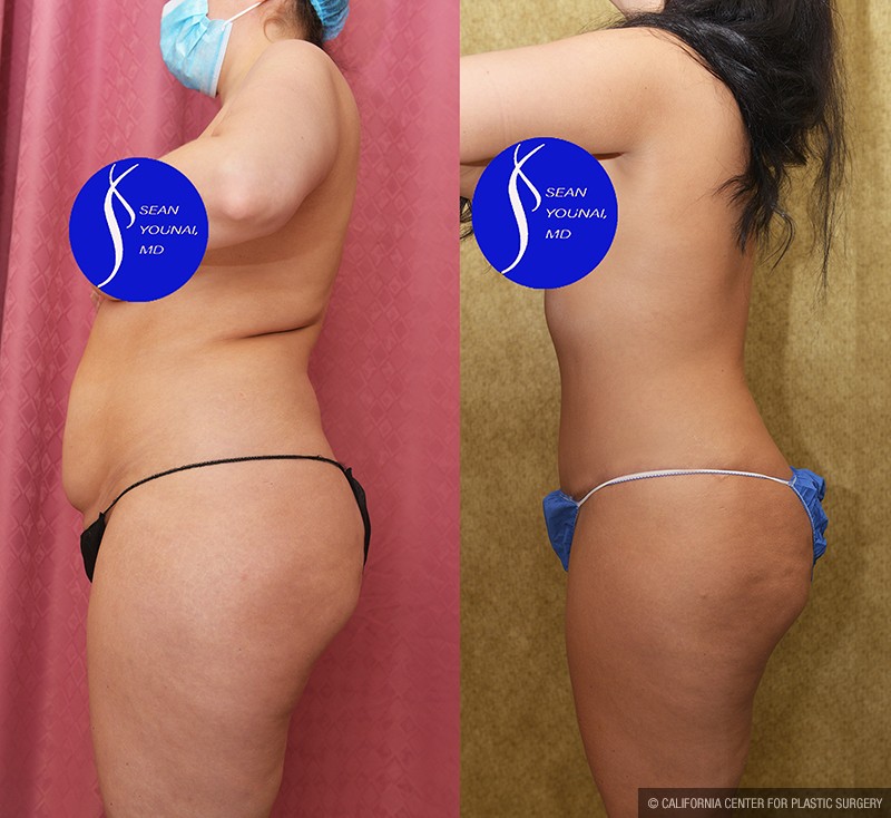 Tummy Tuck (Abdominoplasty) Medium Size Before & After Patient #13686