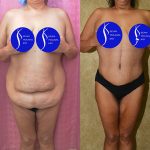 Tummy Tuck (Abdominoplasty) Plus Size Before & After Patient #13687