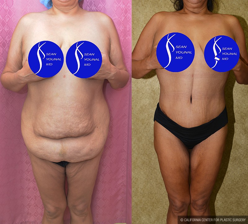Tummy Tuck (Abdominoplasty) Plus Size Before & After Patient #13687
