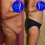 Tummy Tuck (Abdominoplasty) Plus Size Before & After Patient #13687
