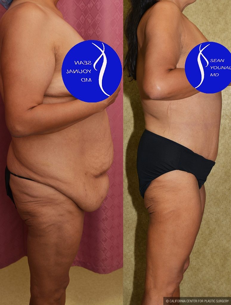 Tummy Tuck (Abdominoplasty) Plus Size Before & After Patient #13687