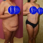 Tummy Tuck (Abdominoplasty) Plus Size Before & After Patient #13687
