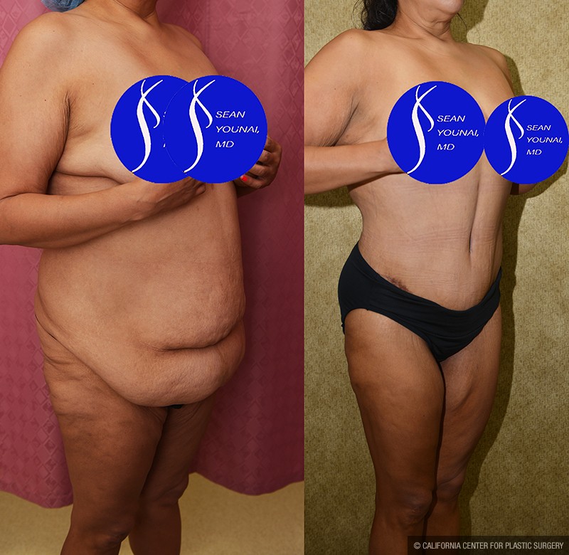 Tummy Tuck (Abdominoplasty) Plus Size Before & After Patient #13687