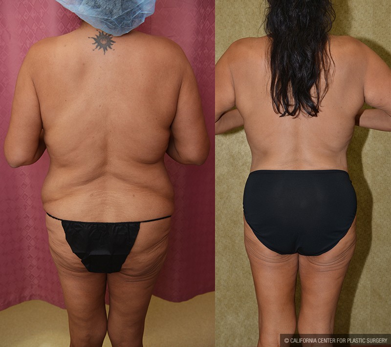 Tummy Tuck (Abdominoplasty) Plus Size Before & After Patient #13687