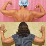 Arm Lift (Brachioplasty) Before & After Patient #13679