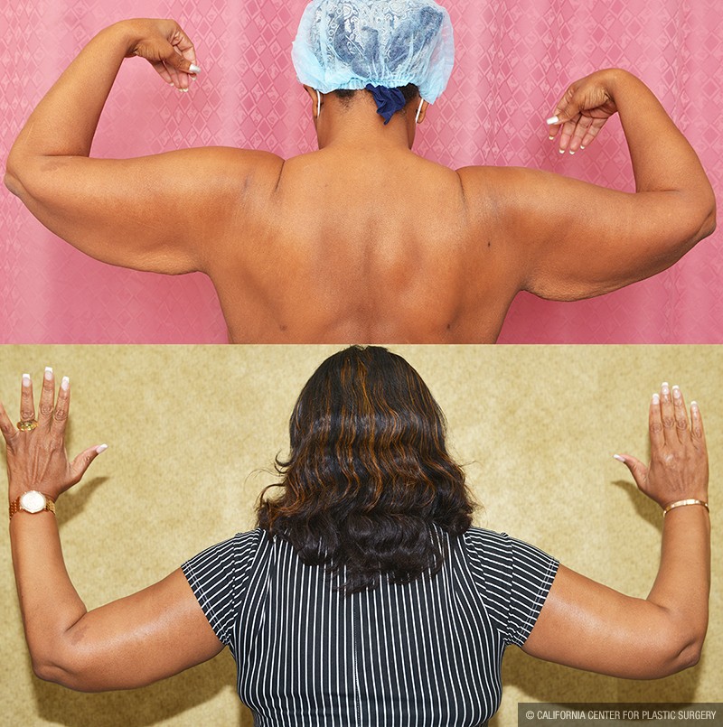 Arm Lift (Brachioplasty) Before & After Patient #13679