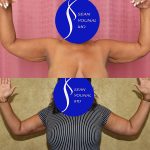 Arm Lift (Brachioplasty) Before & After Patient #13679