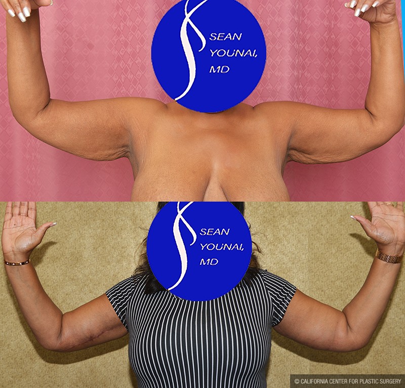 Arm Lift (Brachioplasty) Before & After Patient #13679