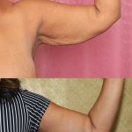 Arm Lift (Brachioplasty) Before & After Patient #13679
