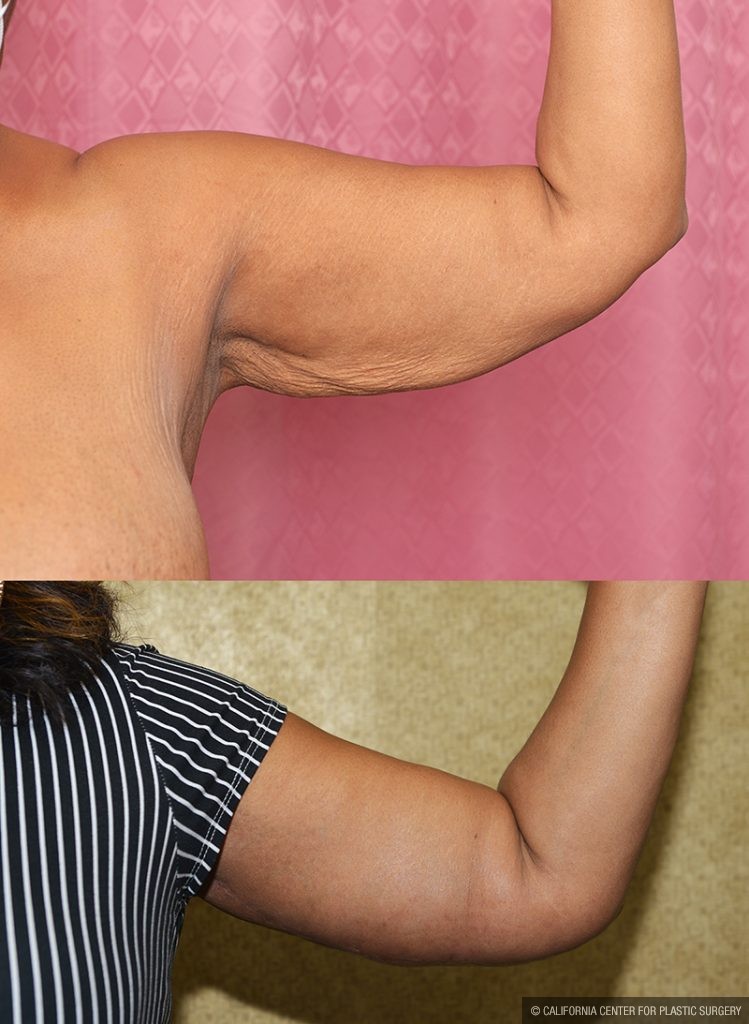 Arm Lift (Brachioplasty) Before & After Patient #13679