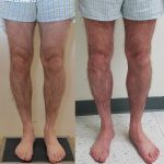 Calf Augmentation Before & After Patient #13680